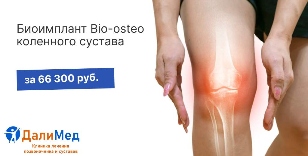 Биоимплант коленного сустава BIO-OSTEO за 66 300 руб.