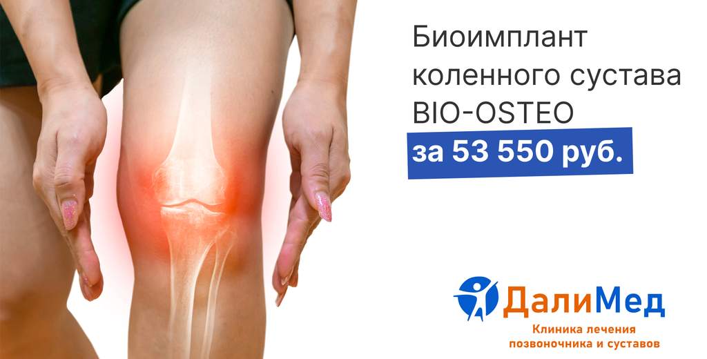 Биоимплант коленного сустава BIO-OSTEO за 53 550 руб.